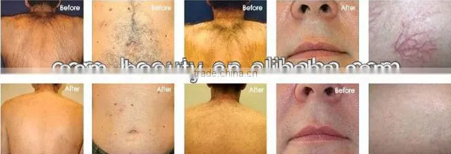 Portable elight IPL hair removal machine keyword ipl