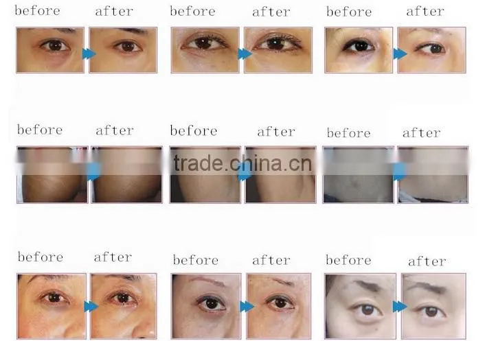 China manufacturer eye wrinkle removal CDT device of ISO9001 Standard