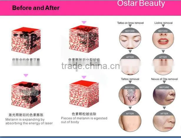 laser treatment portable laser tattoo removal pigmentation treatment equipment TR 03