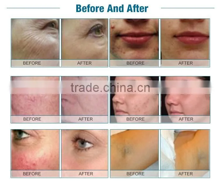 Hot sale elight shr ipl shr hair removal beauty equipment treatment for face and body
