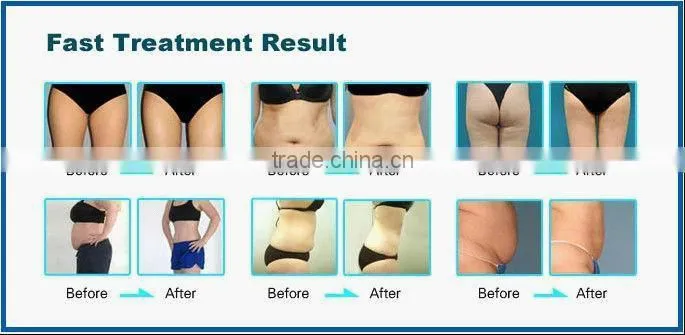 Instant Result vacuum cavitation weight loss equipment
