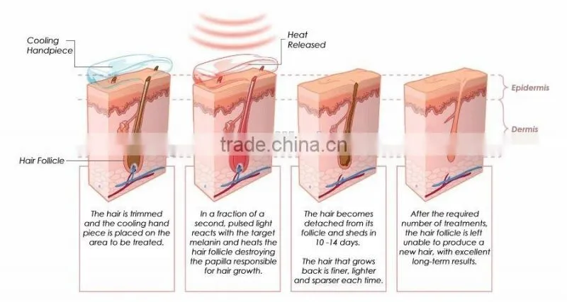 yag laser q switch tattoo removal/yag laser remove tattoo