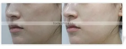 Professional Injection Meso Mesotherapy Gun For Skin Whitening Wrinkle Removal