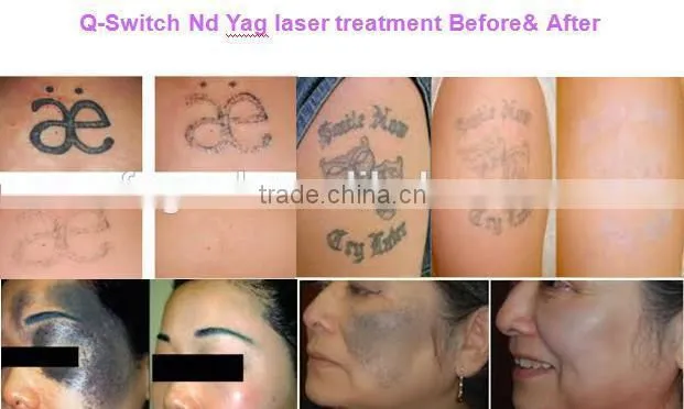 2015 Newest Q Switched Nd Yag Laser Tattoo Remover professional for doctors