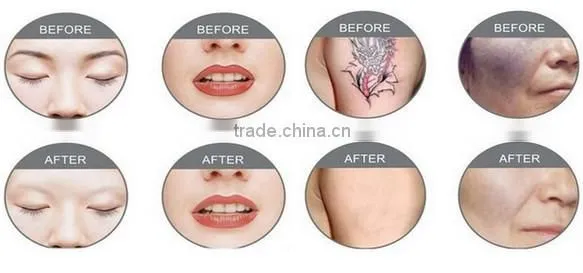 Laser Beauty Machine Q Switched nd:yag Laser Tattoo Removal machine prices