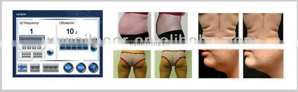 ultrasound lipolysis
