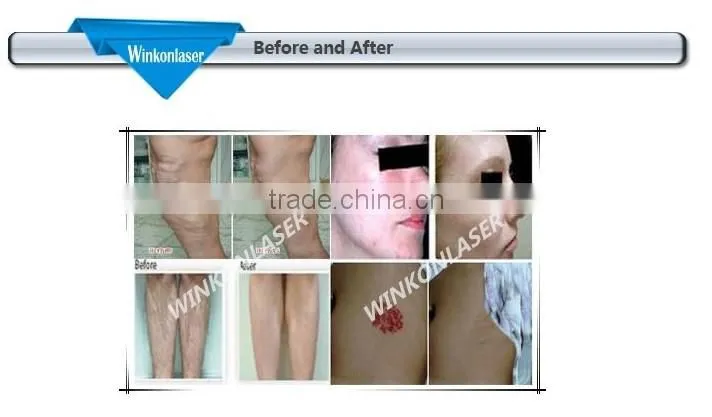 1064nm long pulse nd yag laser for Varicose Veins, blood vessel, spider vein treatment