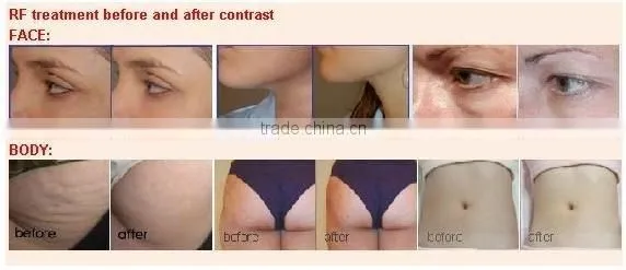 2012 RF facial lifting and firming machine