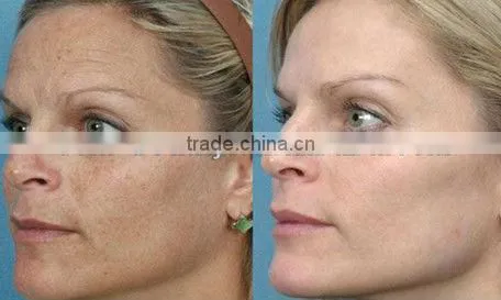 Advanced Intense Pulsed Light IPL Photo Rejuvenation Hair Removal Equipment