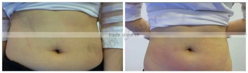 2015 New arrival high quality OD S90 3 in 1 vacuum liposuction ultrasonic cavitation best fast body slimming multipolar rf