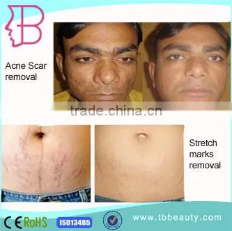 5Mhz Bipolar facial skin tightening devices