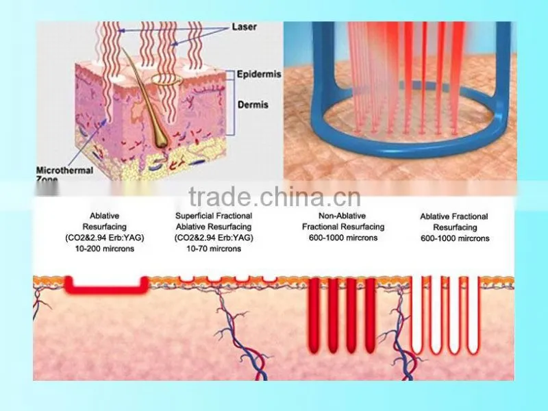 2016 medical equipment wrinkle & scar removal co2 fractional laser/ fractional CO2 vaginal removal