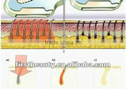 Professional ipl machine with reasonable ipl laser hair removal machine price