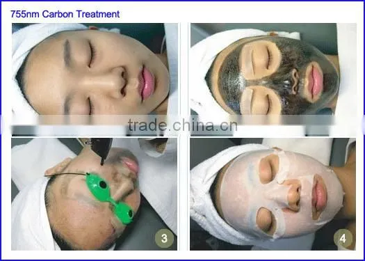 Q switched Nd Yag carbon Laser for skin rejuvenation