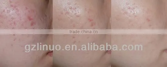 2013-2017 the most professional +powerful 540 needle face massage roller (very HOT in Europe!!!!!!!!!!!)