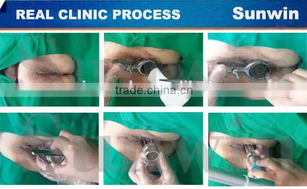 SW-333E-1 Professional fractional CO2 laser vagina tighten surgery