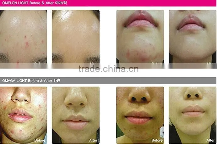 2016 portable pdt led photon light therapy facial rejuvenation acne removal beauty care machine for Salon use
