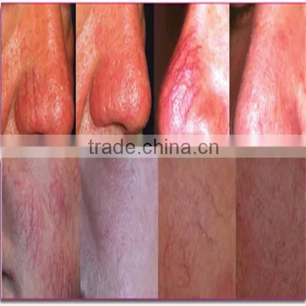best high quality effective laser spider veinremoval machine/ portable laser spider vein removal for home use skin care