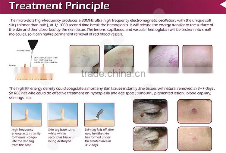 Distributor low price blood vessels removal spider veins treatment for pigmented lesion