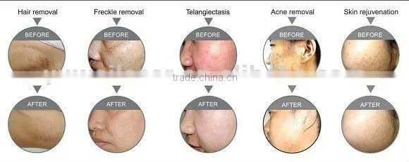 hair removal ipl equipment