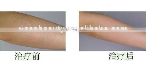 Professional SHR IPL machine ,permanent hair removal /SHR IPL machine keyword 2015 best shr ipl machine for beauty use