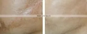 2015 Titanium galvanic derma roller microneedle L005 540 nm