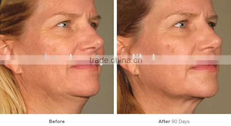 Newest Technology Hifu , Hifu Face Lift , Hifu Machine