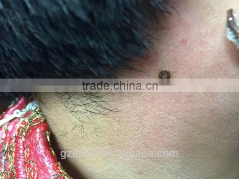hand-held spot removal machine,high frequency current spot removal