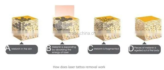 Best Q Switch ND yag Laser for Tattoo Removal Nevus Removal Face Cleaning