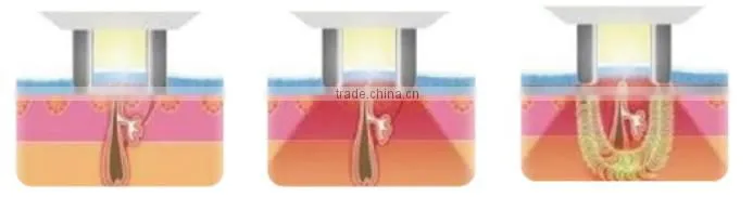 Best Elight IPL RF 3H photo rejuvenation machine