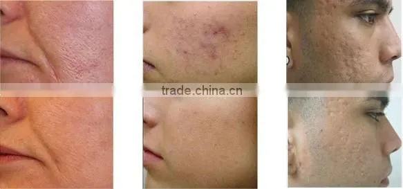 2015 Latest fractional rf micro needle cosmetic laser