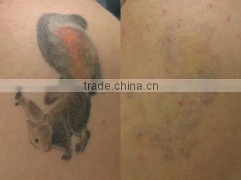 Portable medical design nd yag laser remover tattoo machine 2013