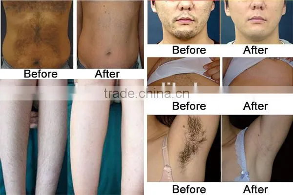 arm hair removal therapy