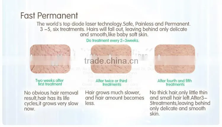 professional 808nm diode laser vertical hair removal beauty equipment
