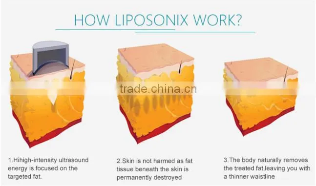 liposonix machine hifu body liposonix slimming machine lipo laser weight loss machine liposonix