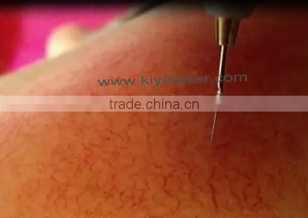 Upgraded power board! vascular removal laser