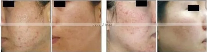 Best RF CO2 fractional laser skin treatment machine for chloasmas and pigmentation removal OY-11