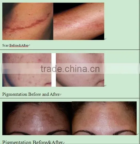 Skin Care,Skin Rejuvenation Co2 Fractional Laser Device
