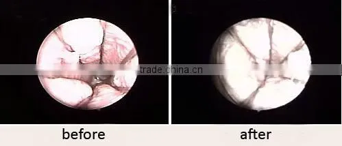 medical vaginal tightening co2 laser machine