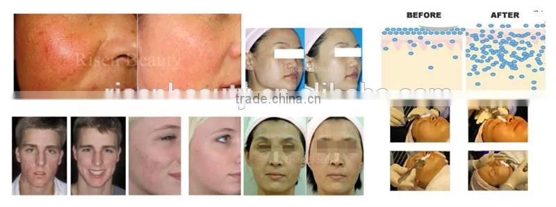 auto micro needle electric micro needling Derma pen