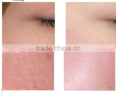 Langdi professional best water oxygen jet peel machine with ce