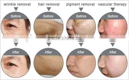 2016 HOTTEST CE / FDA certificated Permanent hair removal rf machine shr ipl