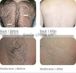 Newest IPL hair removal beauty salon beauty equipment
