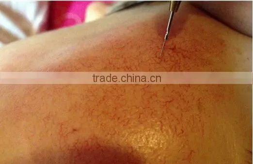 Hottest in the market!!!! super 30mhz Ultra high freqeuncy spider vein removal