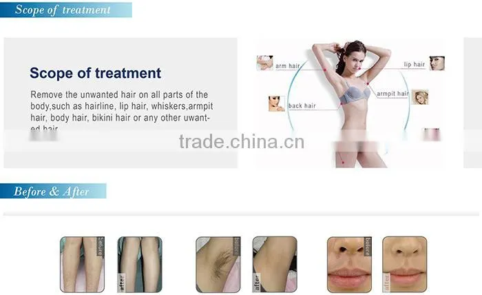 Portable home use diode laser hair removal