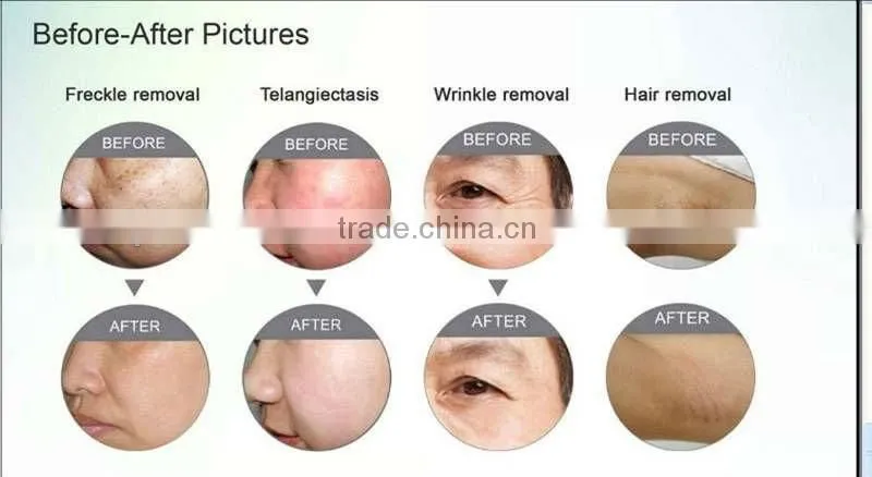 To make you perfect product mini ipl for hair removal-on promotion