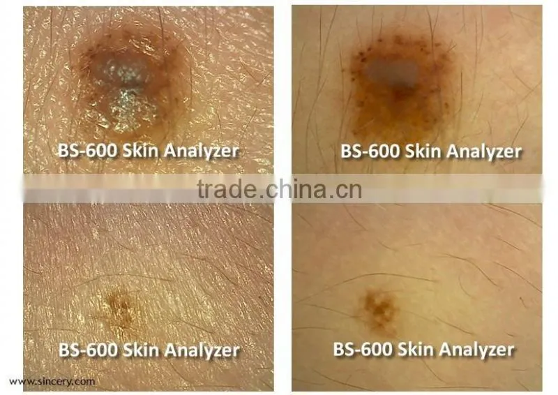 Home, salons and clinics using portable skin tightening skin analyzer