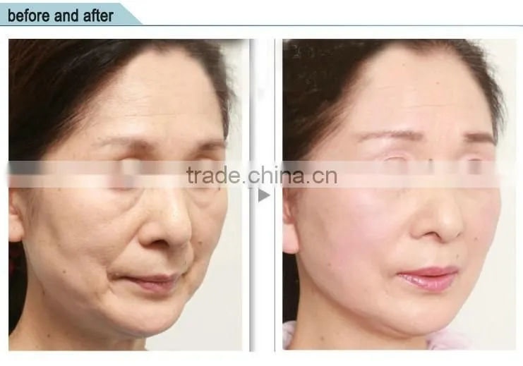 Laptop High Intensity Focused Ultrasound For wrinkle removal