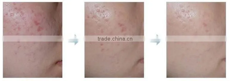 MT Photon Microneedle Dema Skin Roller with Led Light and Replaceable Head