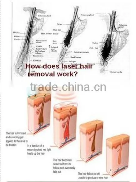 diode laser therapy device,bikini diode laser,808 diode laser beauty equipment